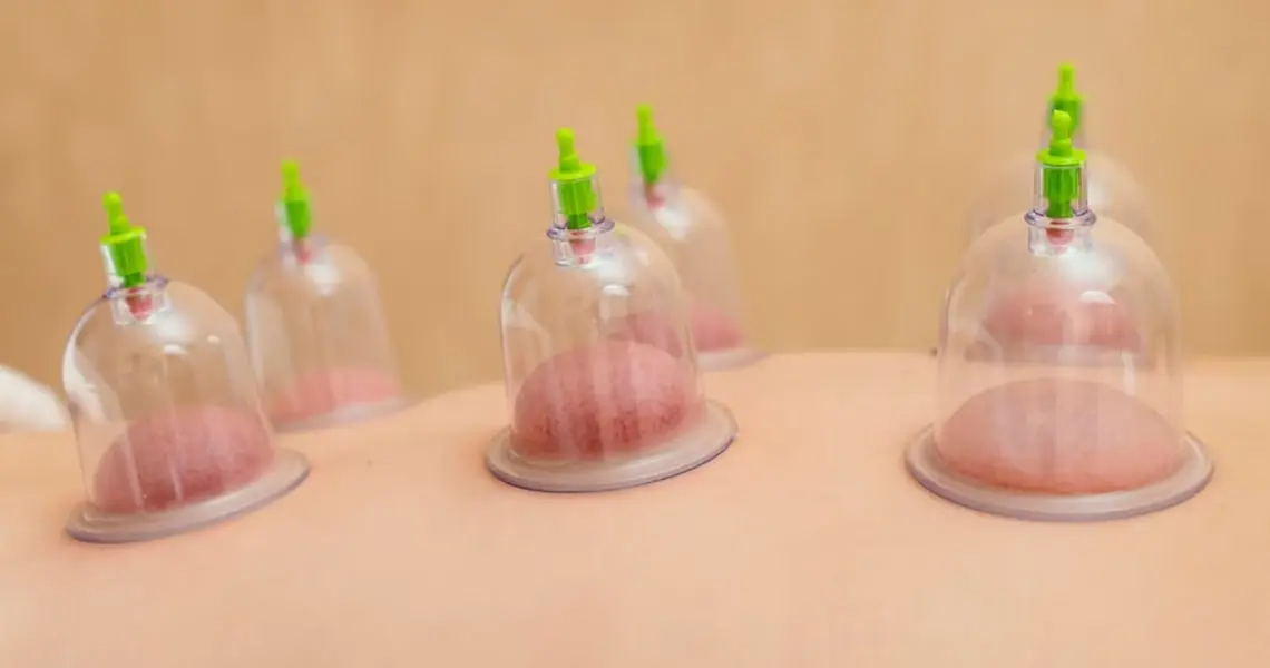 Cupping Therapy Chiropractor